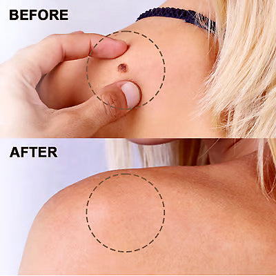 Bee Venom Wart Removal Cream