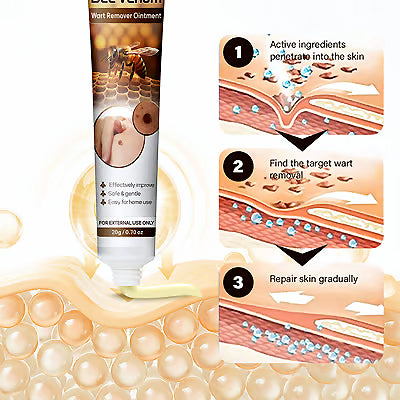 Bee Venom Wart Removal Cream